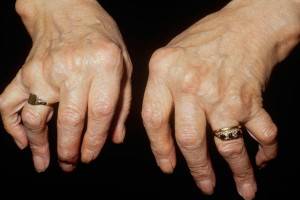 Hands affected by Rheumatoid Arthritis