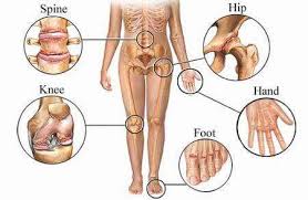 Most common areas affected by arthritis